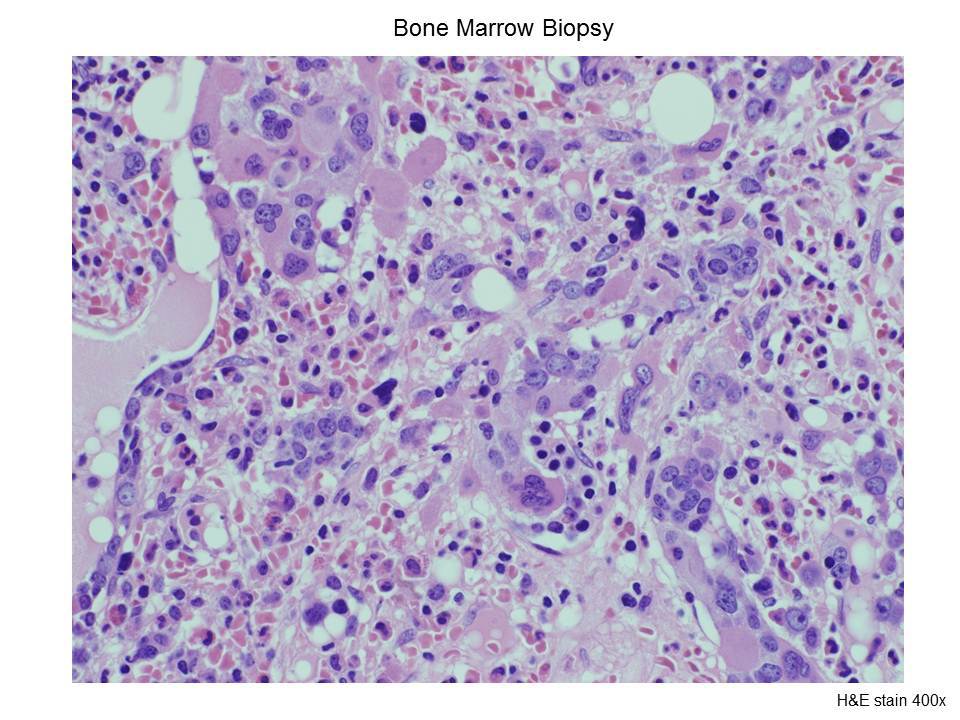 Fig. 5 Bone Marrow Biopsy