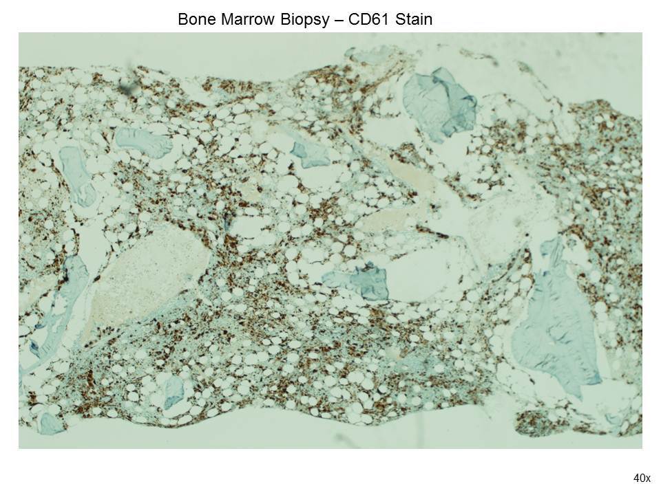 Fig. 7 CD61 Stain