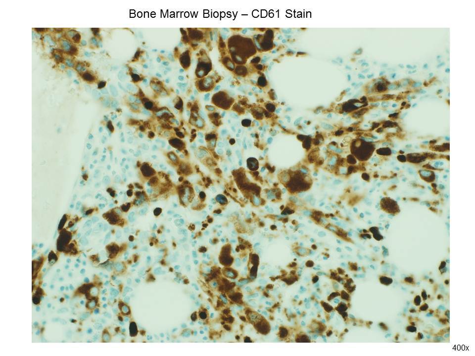 Fig. 8 CD61 Stain