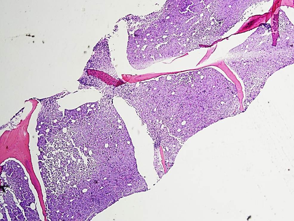 Bone Marrow Biopsy, 4X