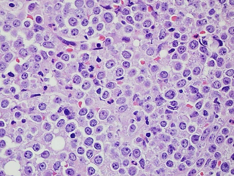 Bone Marrow Biopsy, 60X