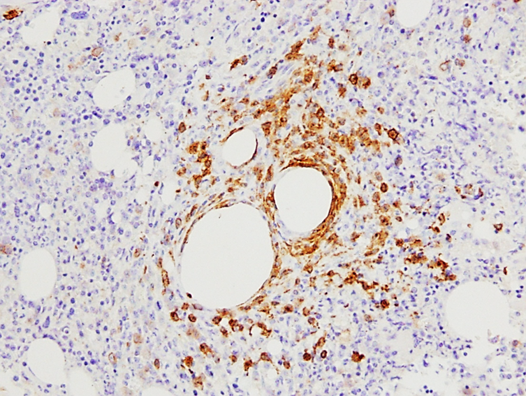 Bone Marrow Biopsy, CD117