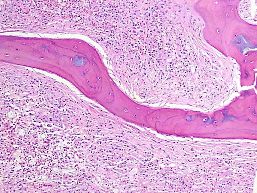Bone Marrow Biopsy, 20X