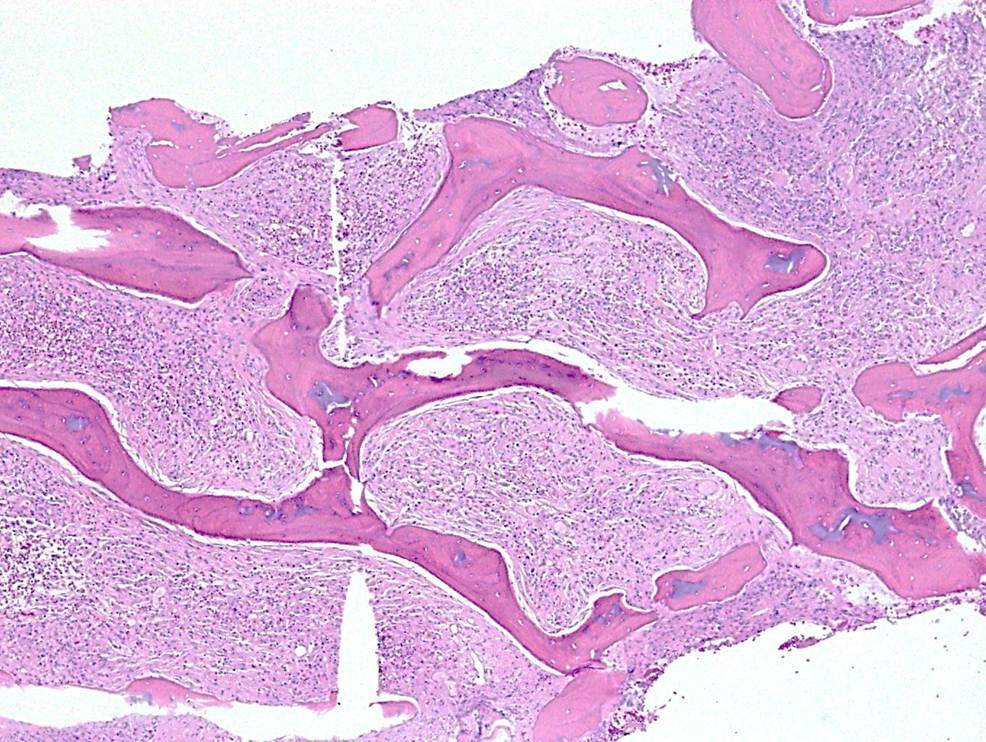 Bone Marrow Biopsy, 4X