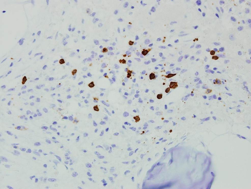 Bone Marrow Biopsy, CD20