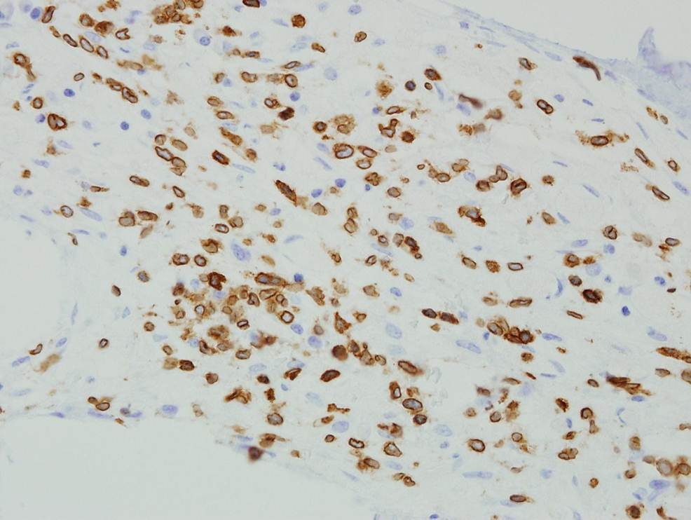 Bone Marrow Biopsy, CD3