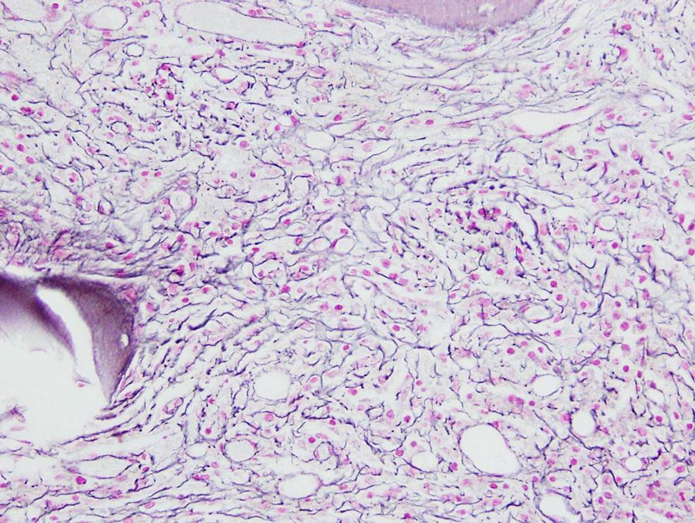 Bone Marrow Biopsy, Gordon and Sweet Reticulin Stain