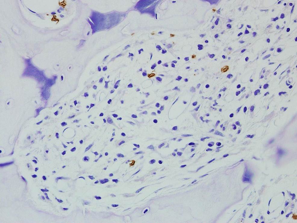 Bone Marrow Biopsy, Glycophorin A
