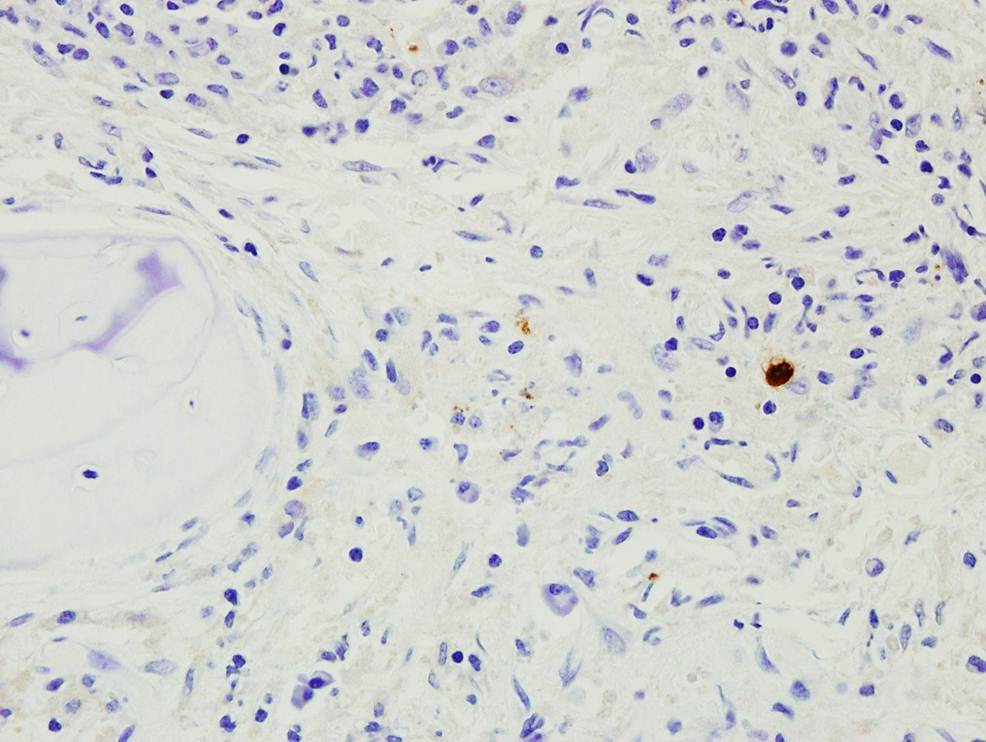Bone Marrow Biopsy, Myeloperoxidase