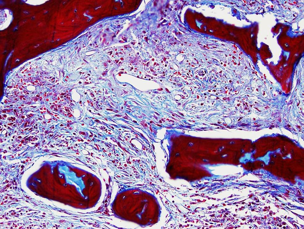 Bone Marrow Biopsy, Masson