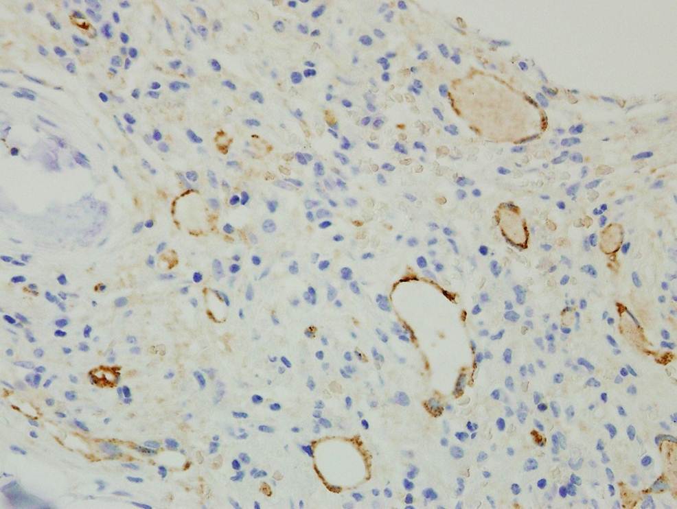 Bone Marrow Biopsy, Factor VIII