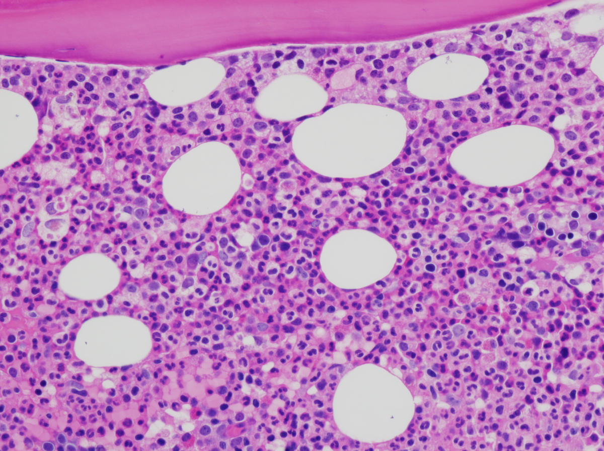 The staging bone marrow biopsy was negative for any lymphomatous infiltrates or acute leukemia.  H&E stained sections of the bone marrow core biopsy showed focal expansion of granulocytic cuffs.