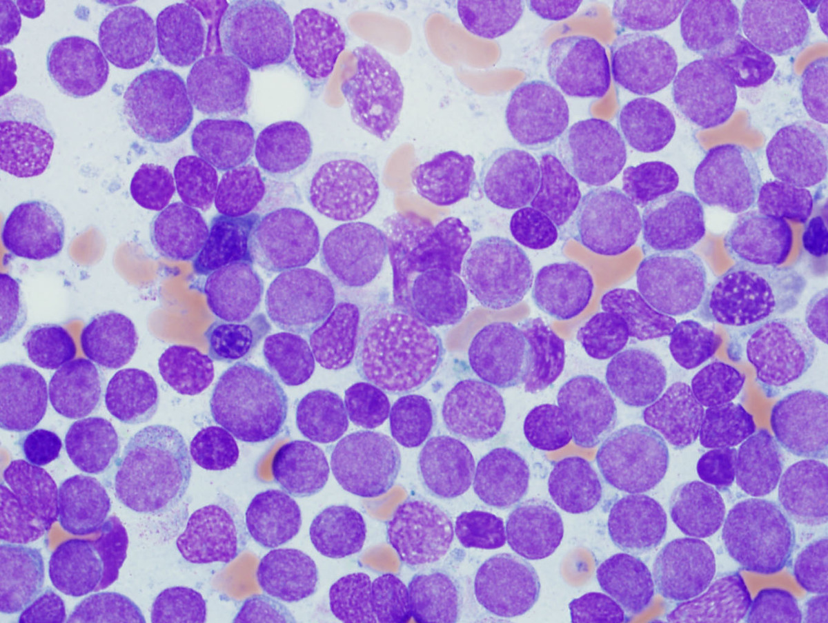 Bone marrow aspirate containing 95% blasts