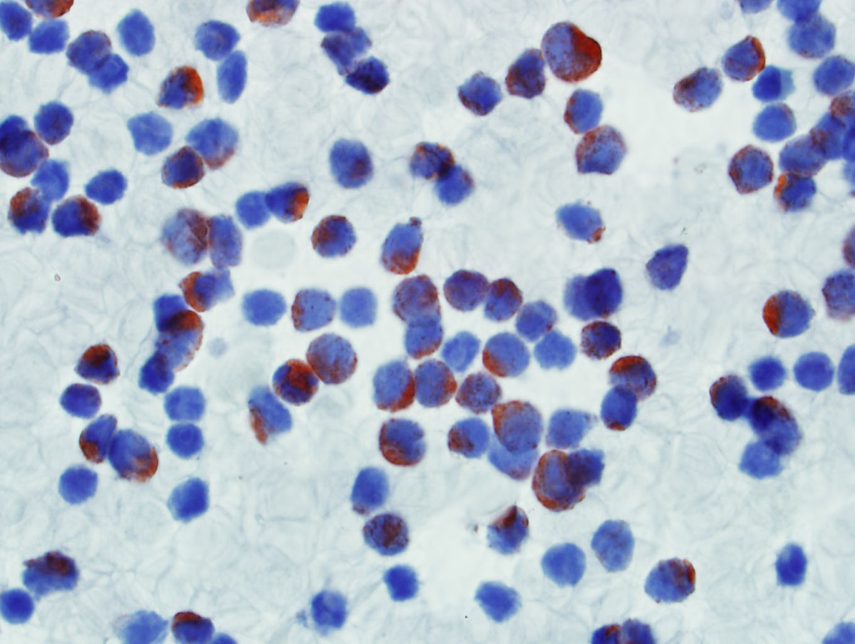 Myeloperoxidase cytochemical stain positive in many of the blasts