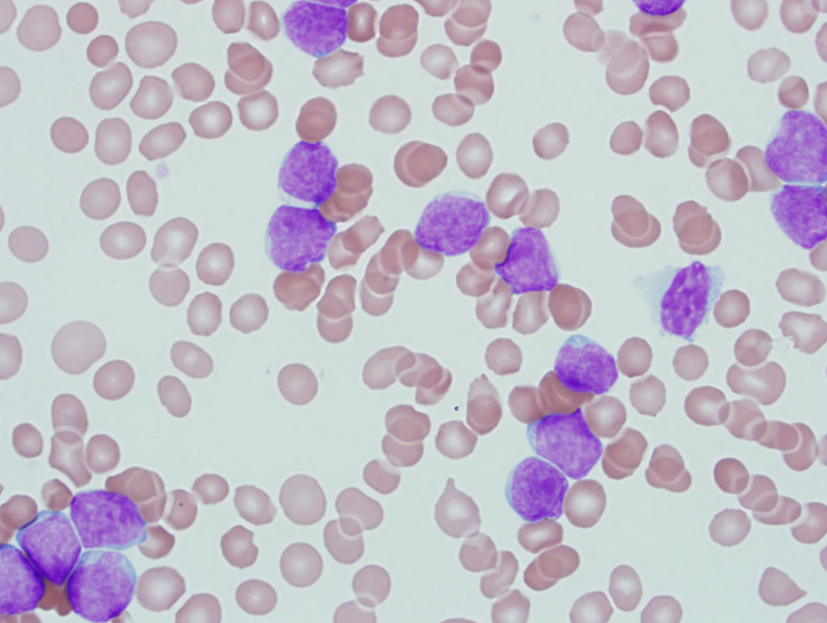 Peripheral blood with numerous circulating blasts