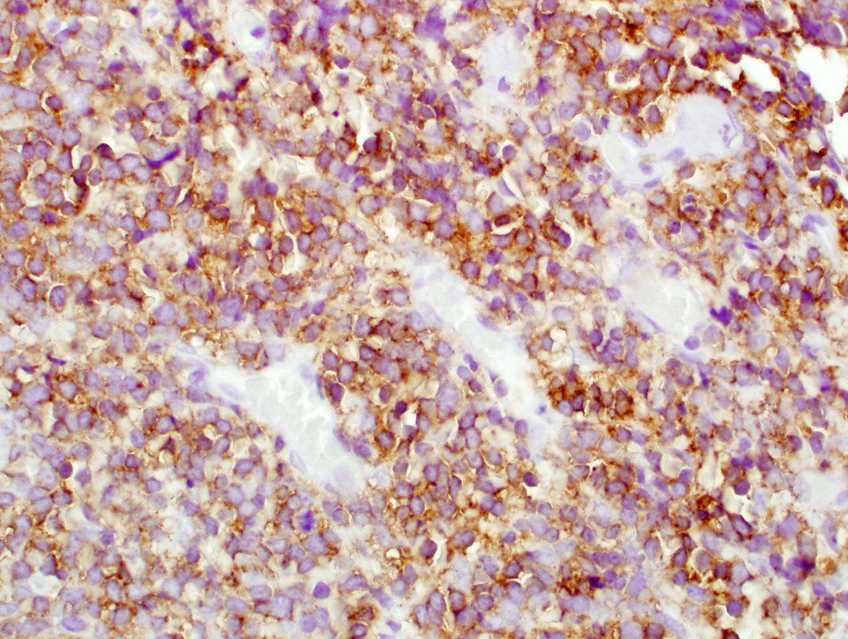 CD117 staining of the neoplastic cells in the lymph node biopsy