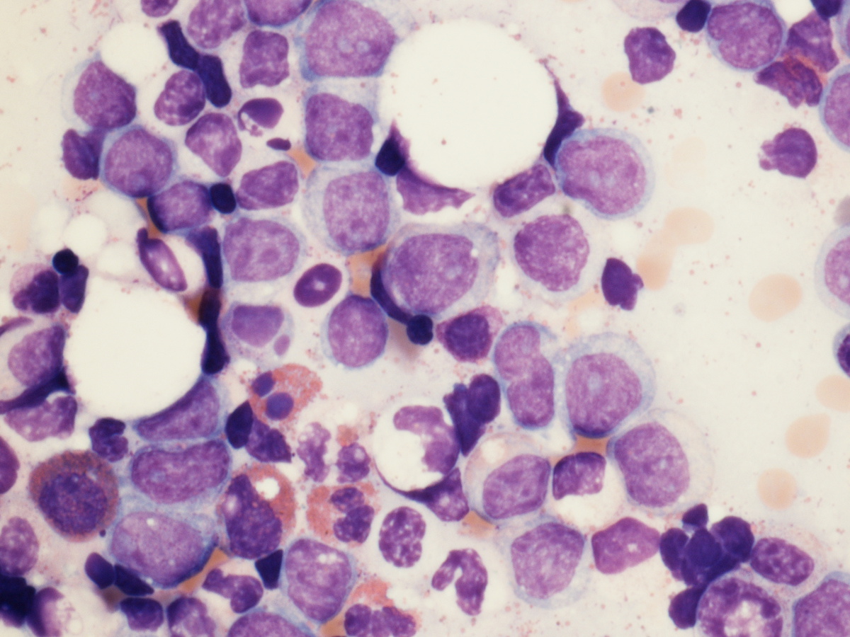 Myeloblasts