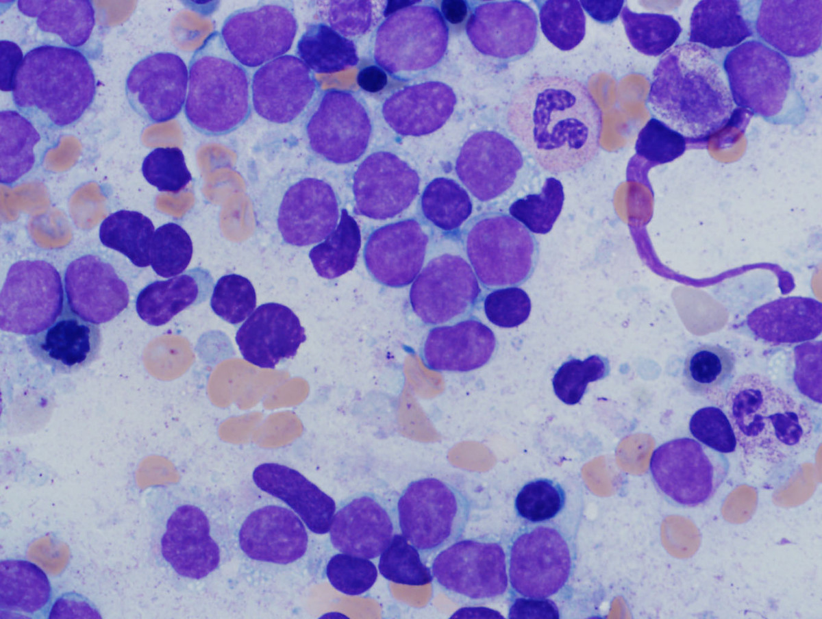 The bone marrow aspirates smears show a predominant population of blasts with scant agranular cytoplasm. Trilineage hematopoiesis is present but relatively diminished.