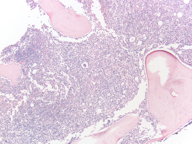 Bone marrow biopsy, HE 1