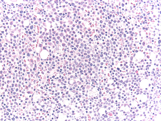 Bone marrow biopsy, HE 2
