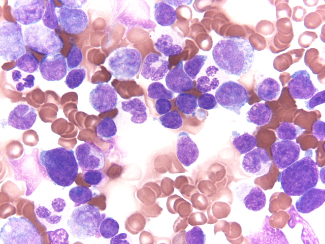 bone marrow aspirate smear 1
