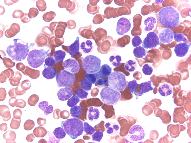 bone marrow aspirate smear 2