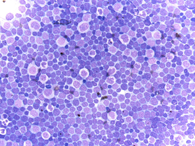 Lymph node biopsy, Touch Prep