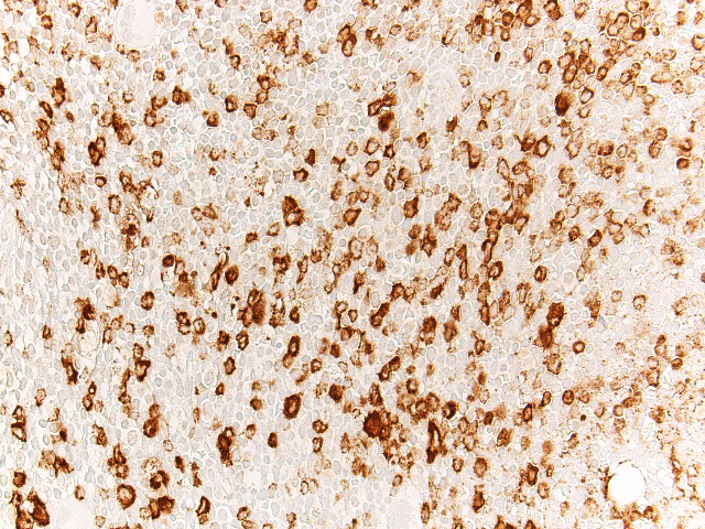 Bone marrow biopsy, MPO