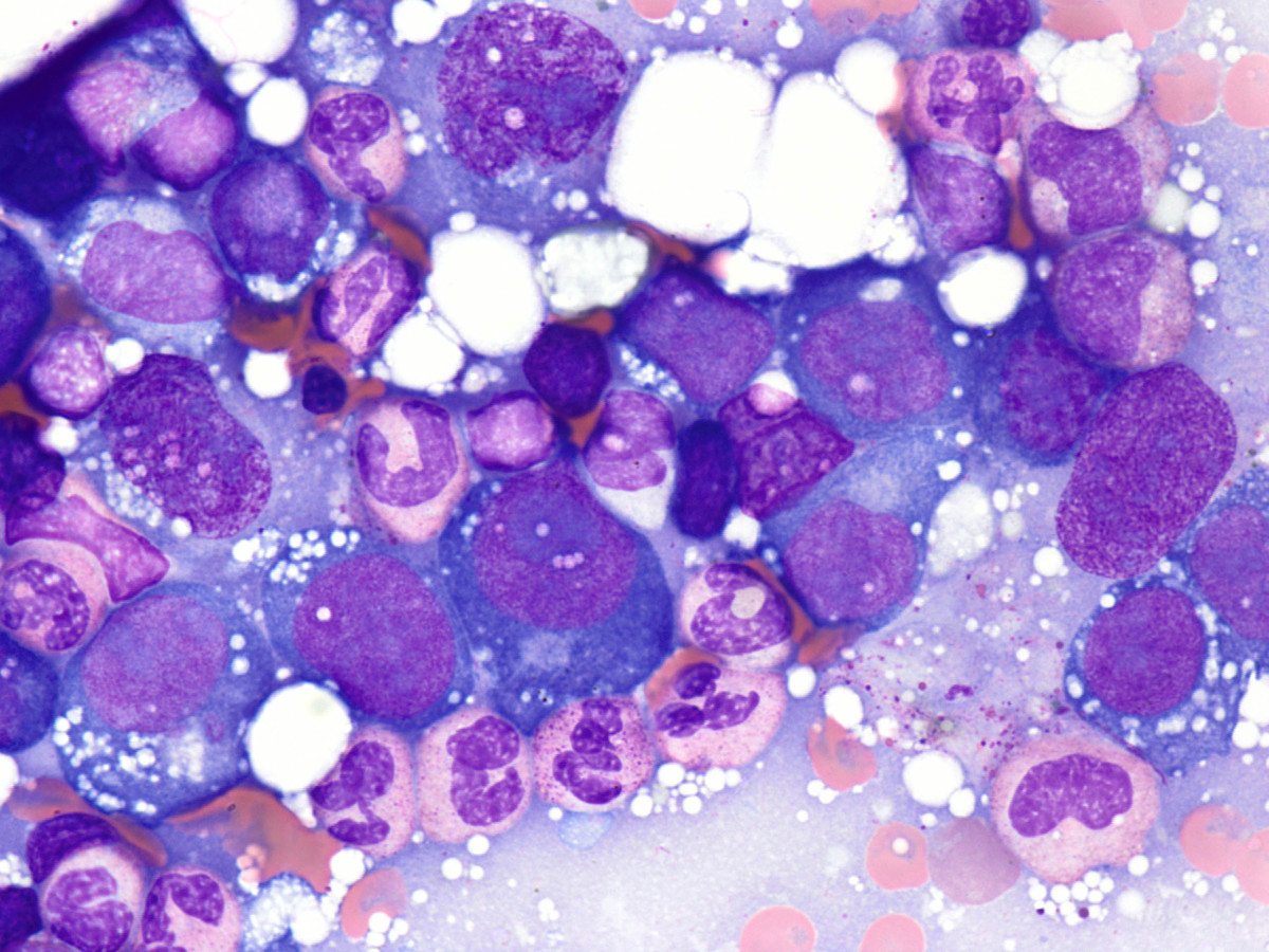 Relapse erythroid blasts