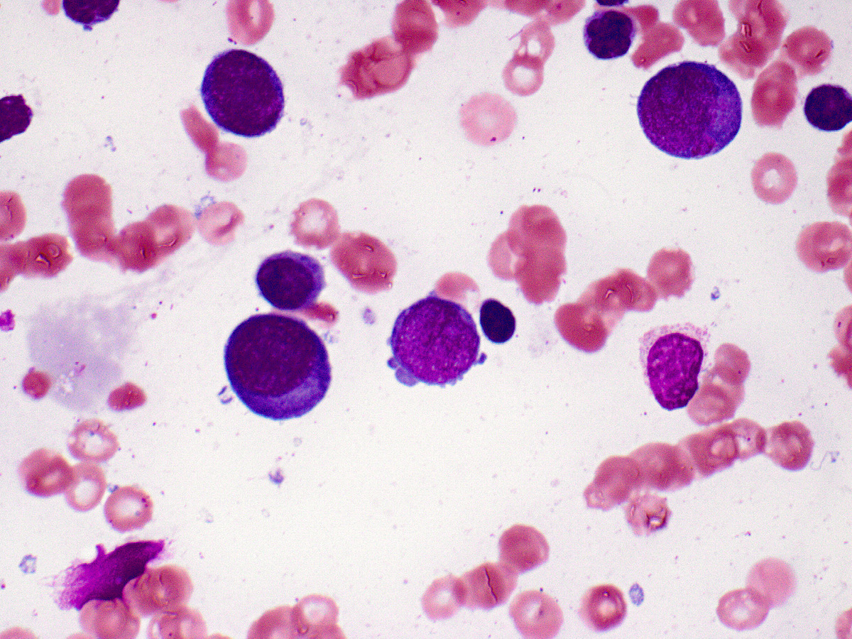 Initial marrow erythroid blasts