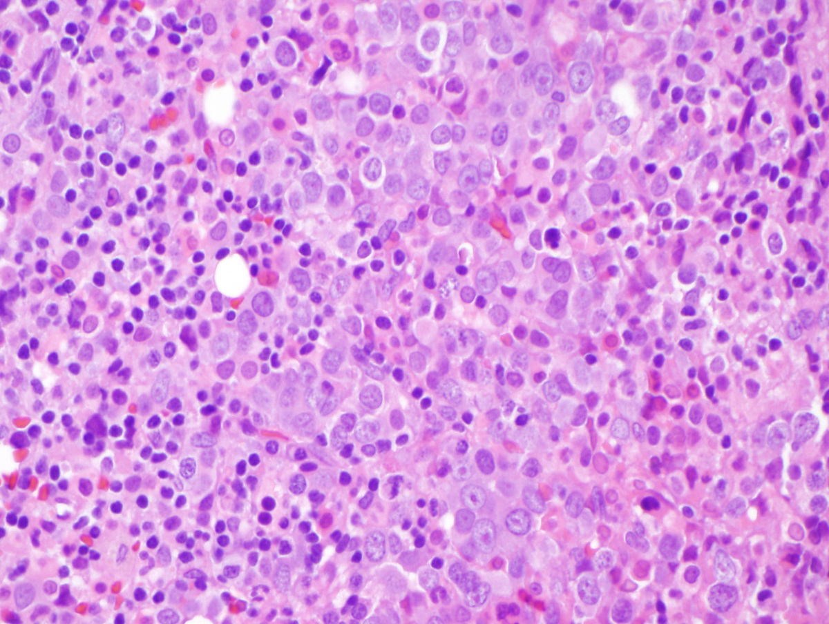 Initial marrow core biopsy high magnification