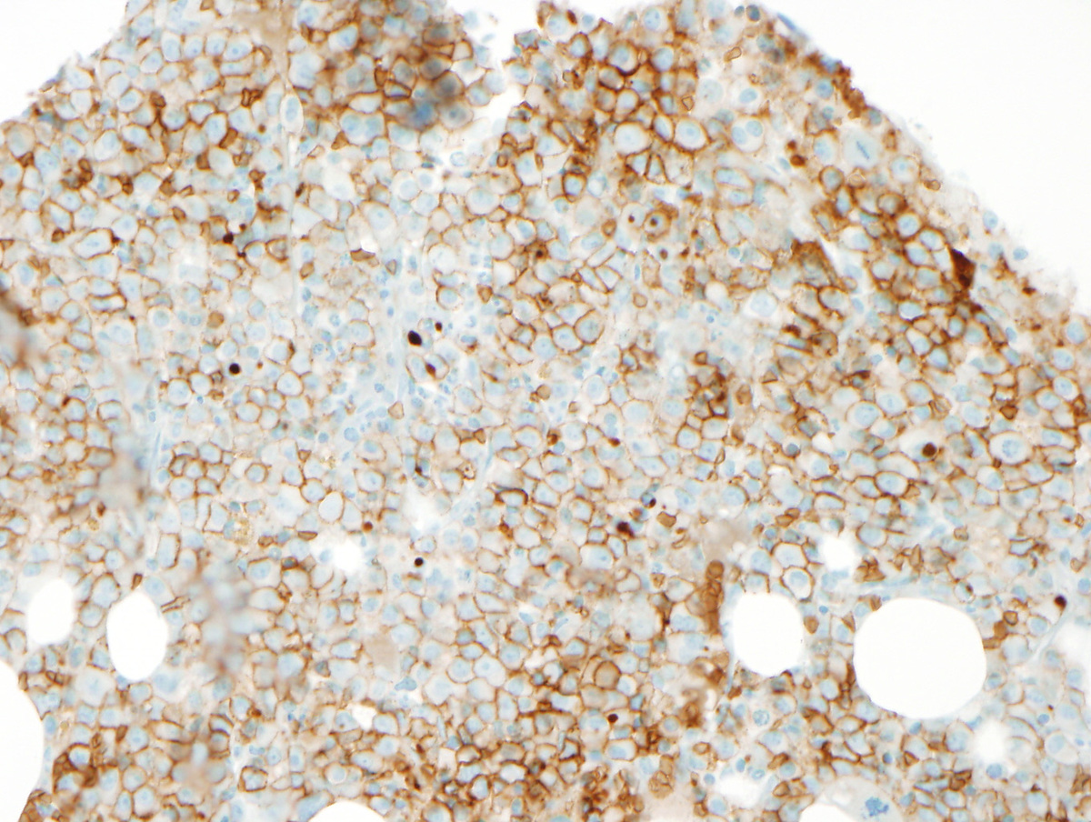 Relapse glycophorin IHC