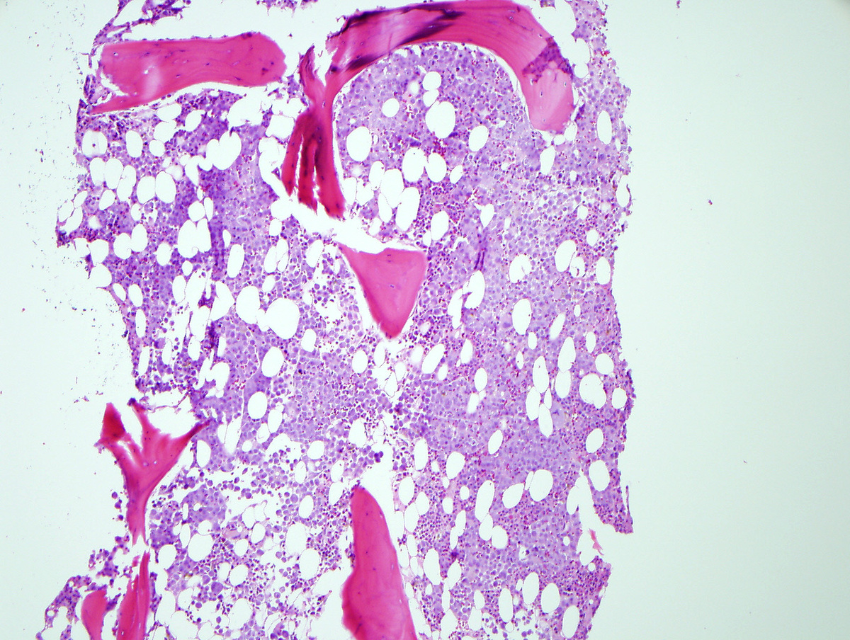 Relapse core biopsy low magnification