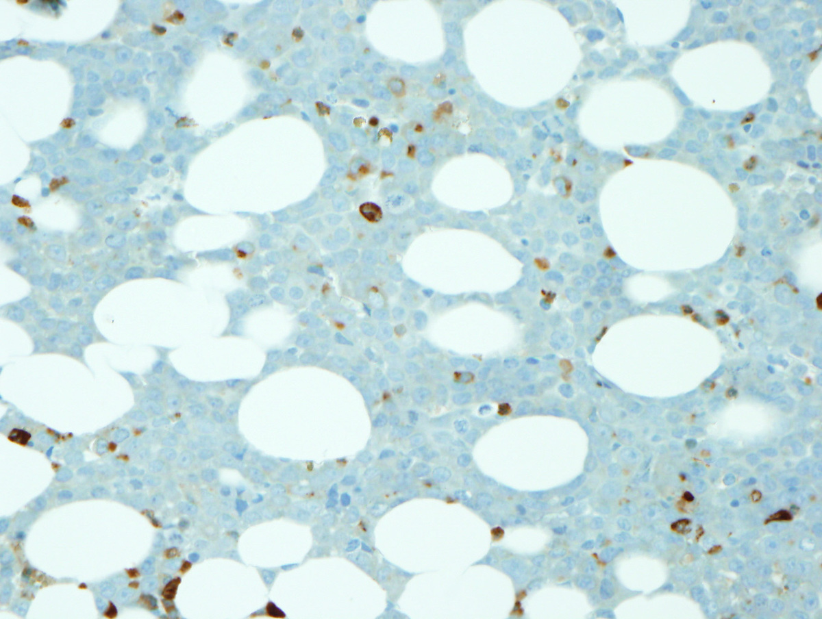 Relapse lysozyme IHC