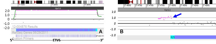 Translocation aCGH revealed gene rearrangements involving ETV6 (A) and FLT3 (B).