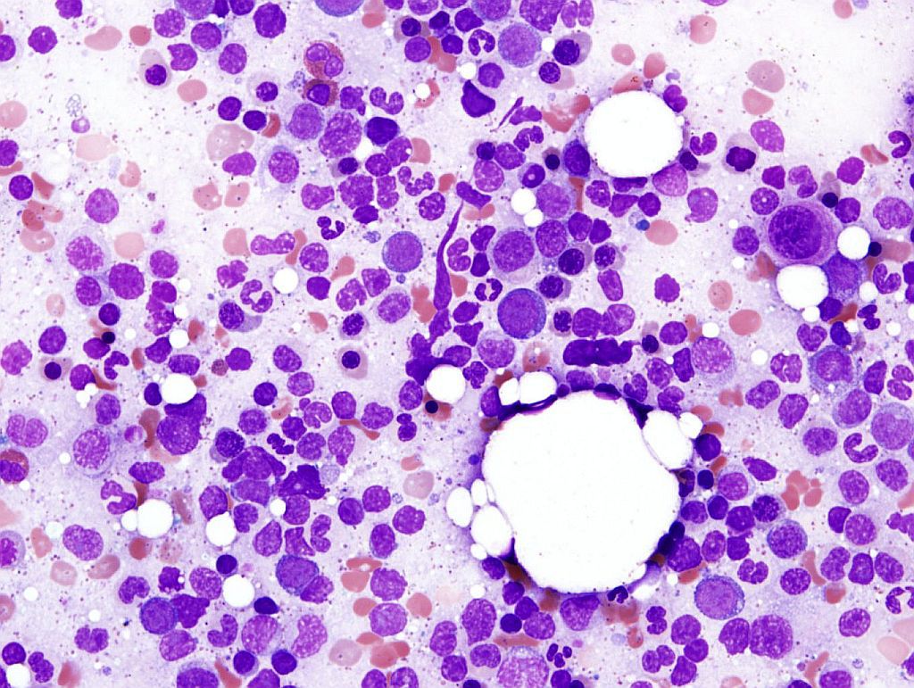 Fig 1. Bone marrow aspirate showing trilineage hematopoiesis with mildly megaloblastoid erythropoiesis and small hypolobated megakaryocytes (Giemsa stain, 60X magnification, oil)