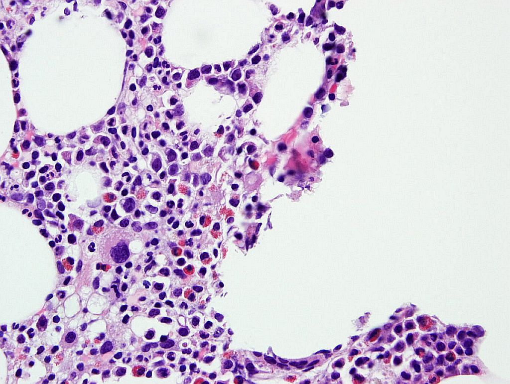 Fig 2. Bone marrow core biopsy, normocellular showing small hypolobated megakaryocytes (H&E, 60X magnification, oil)
