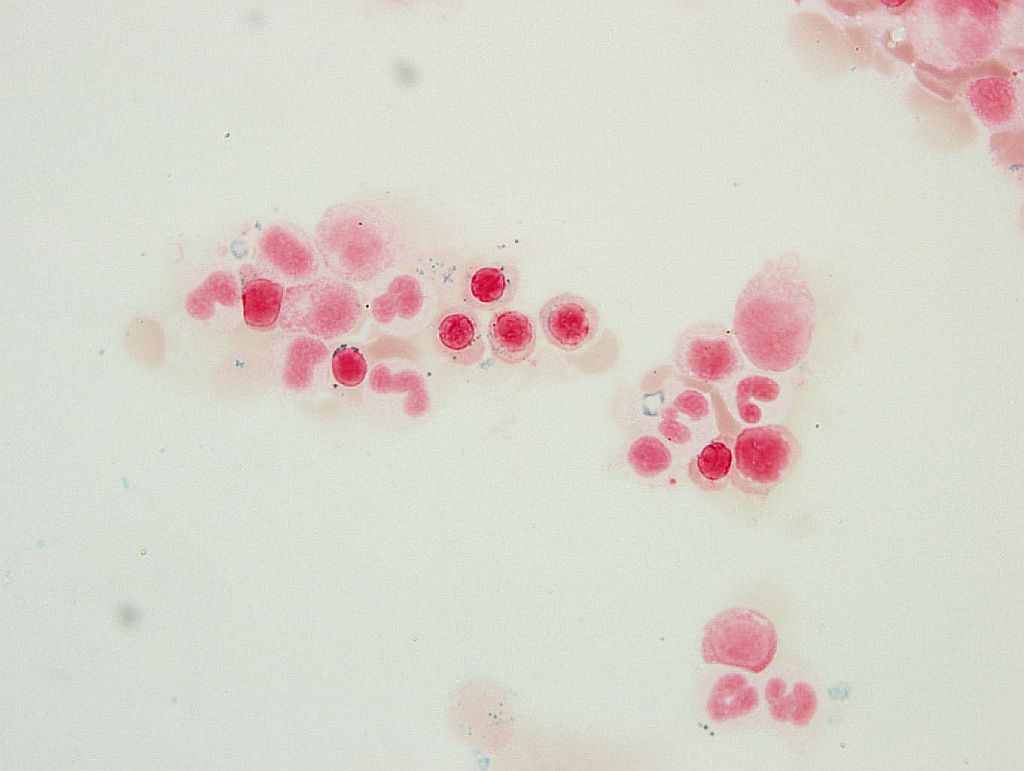 Fig 3. Bone marrow aspirate showing few ringed sideroblasts, <5% (Prussian Blue stain, 60X magnification, oil)