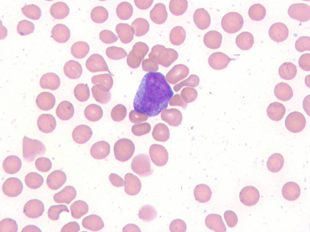 Blasts in bone marrow aspirate smear 