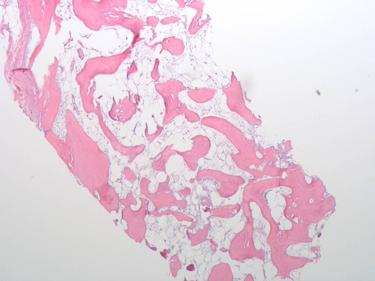 Sparse hematopoeisis in sub-cortical bone marrow biopsy