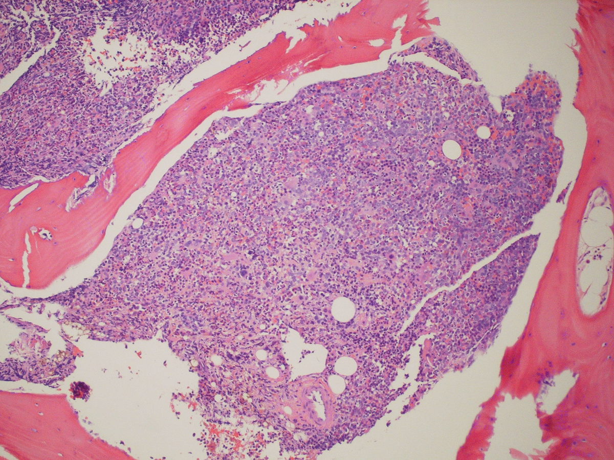 Hypercellular bone marrow biopsy 2009