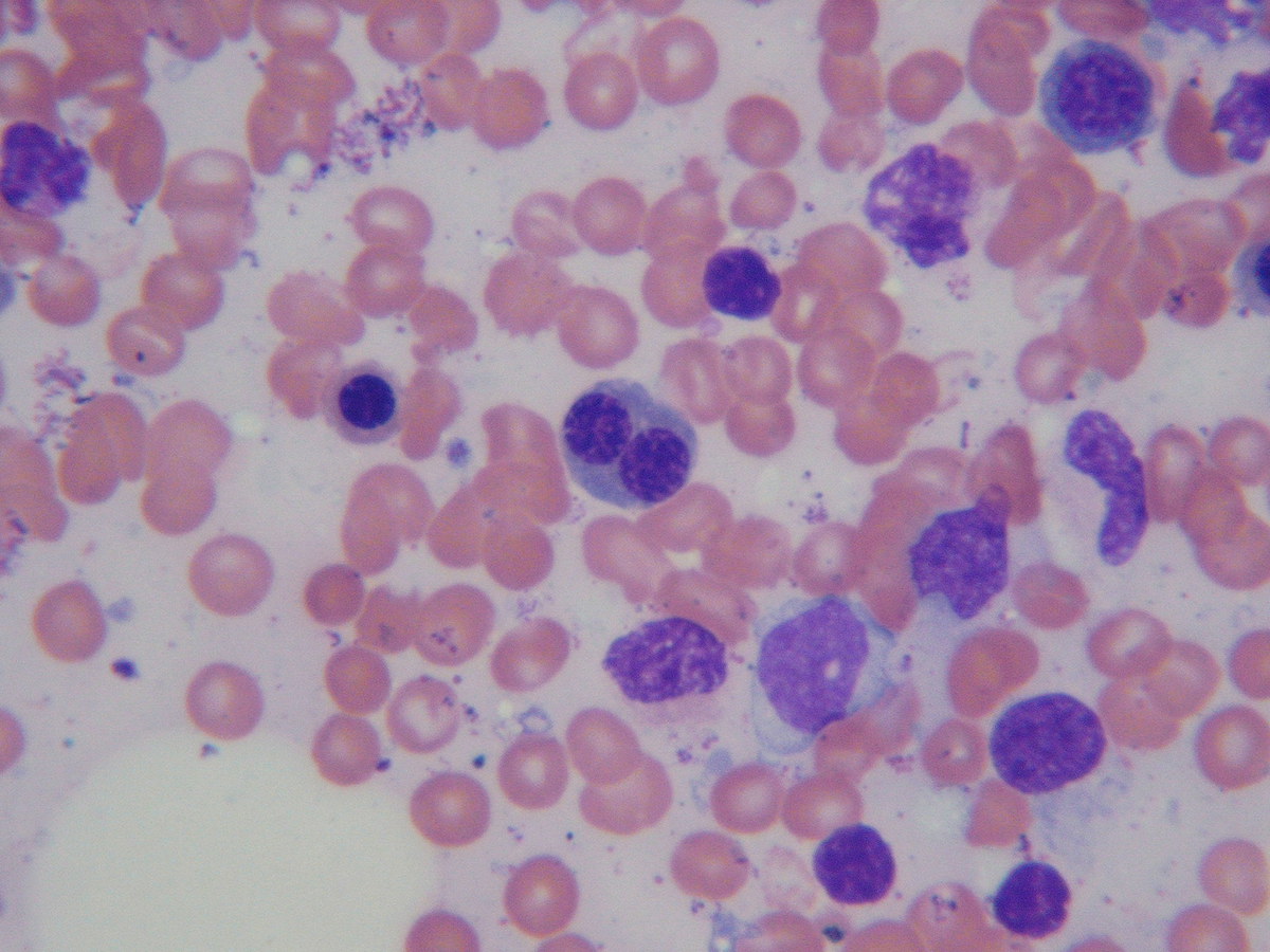Bone marrow touch preparation 2009 showing dyplastic erythroid precursor