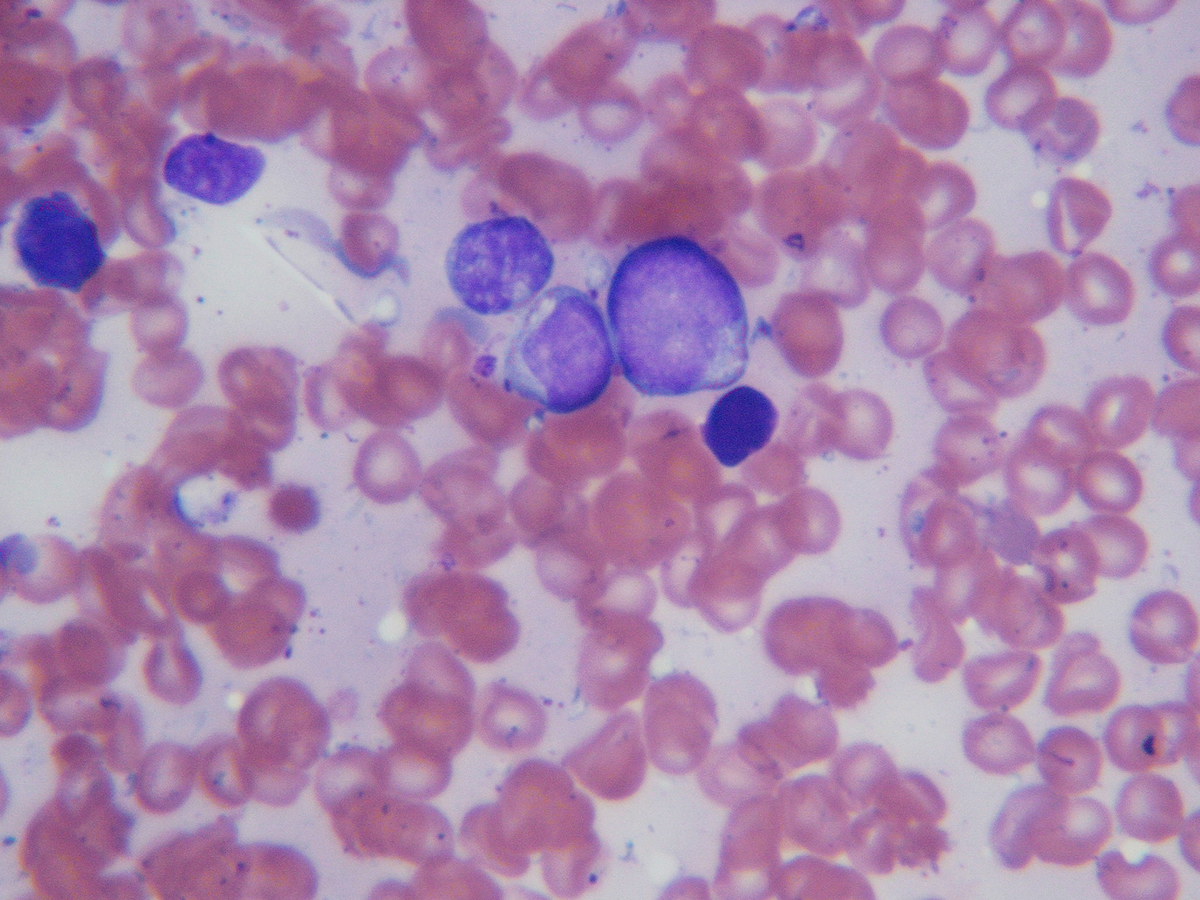 Bone marrow touch preparation 2009 showing blasts