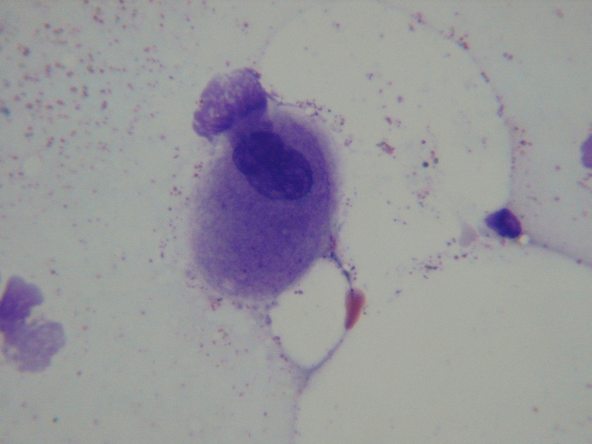 Bone marrow aspirate 2010 showing chronic phase CML small hypolobated megakaryocytes