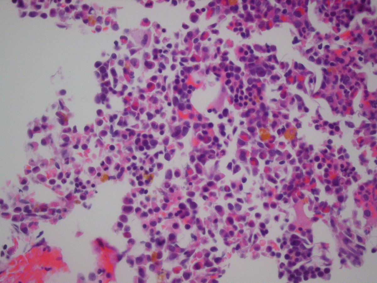 Bone marrow biopsy 2010 showing chronic phase CML