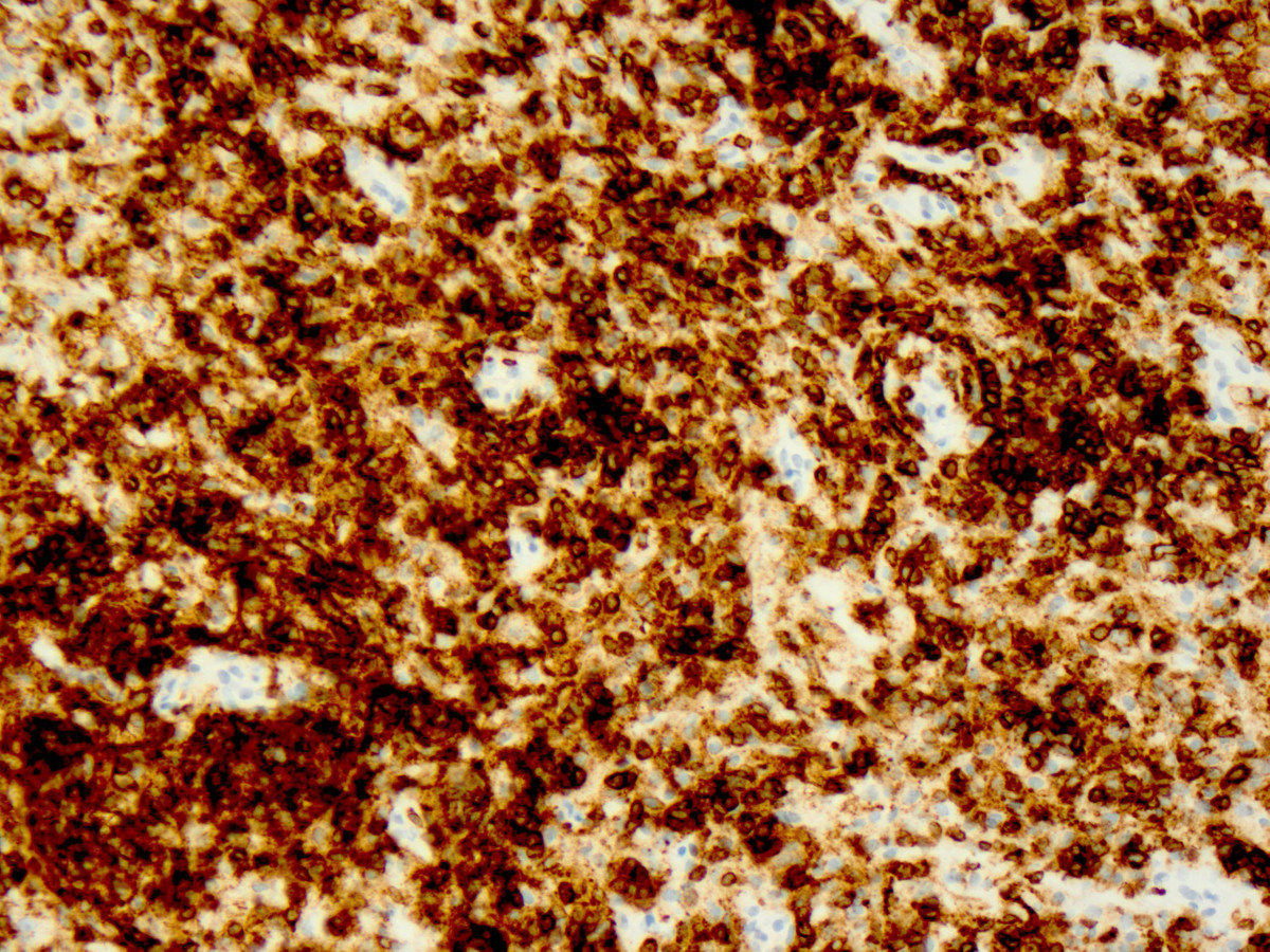 Mediastinal mass post-treatment biopsy (CD1a)