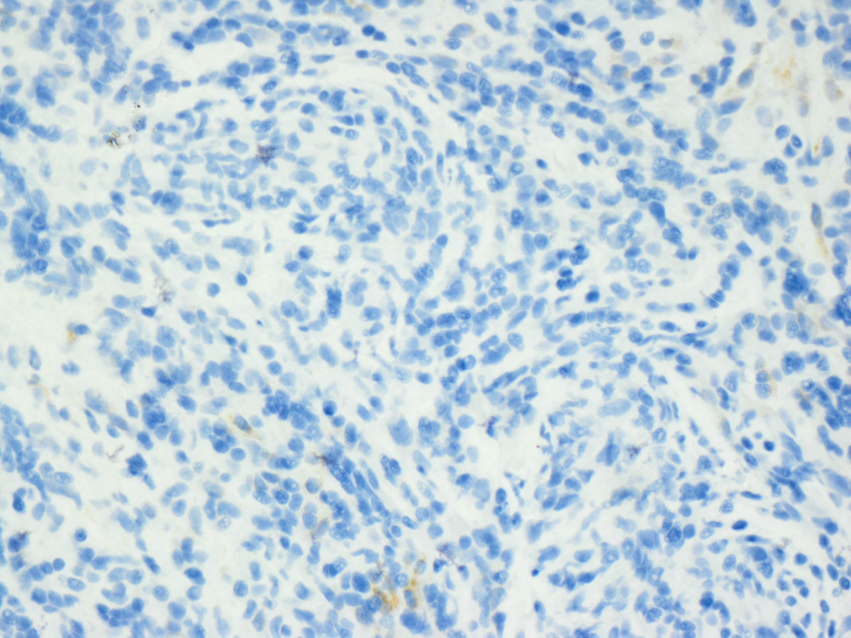 Mediastinal mass post-treatment biopsy (cytokeratin)