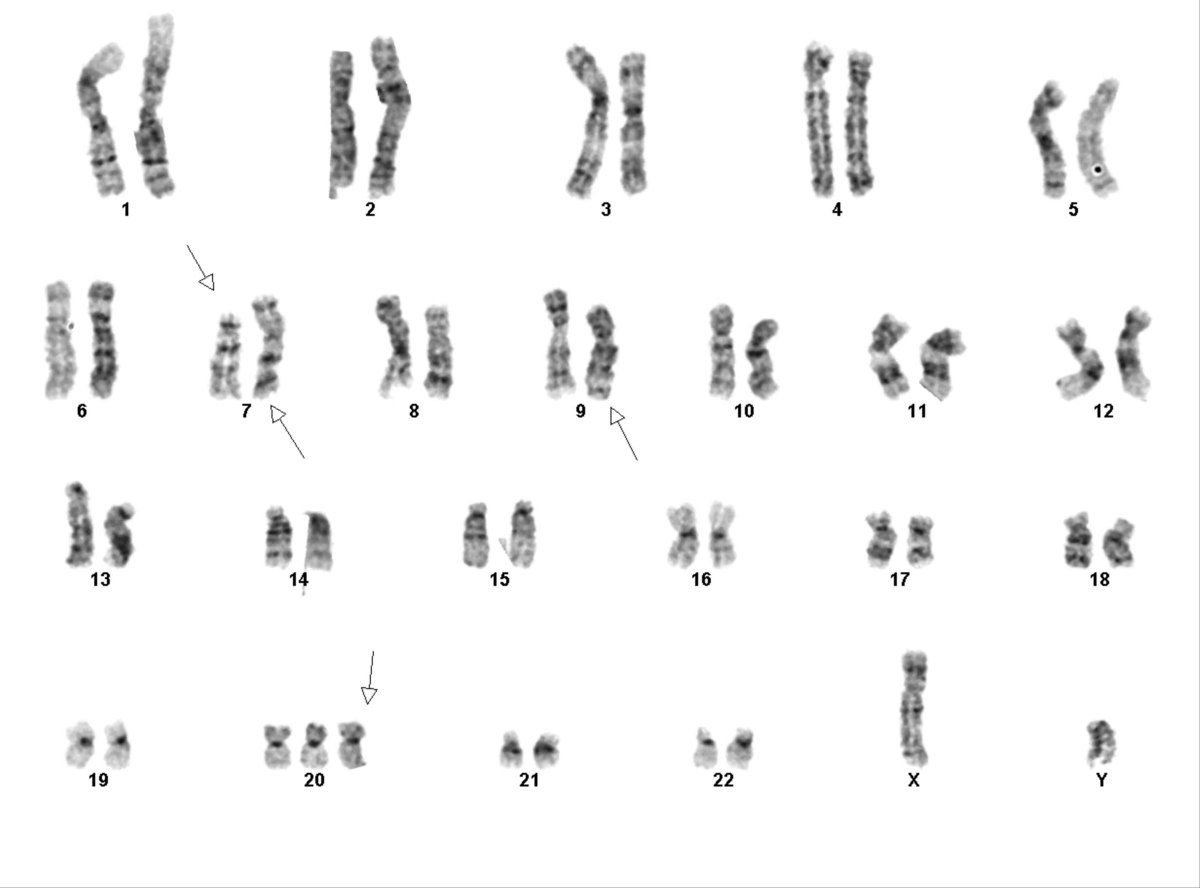 Karyotype of pleural fluid