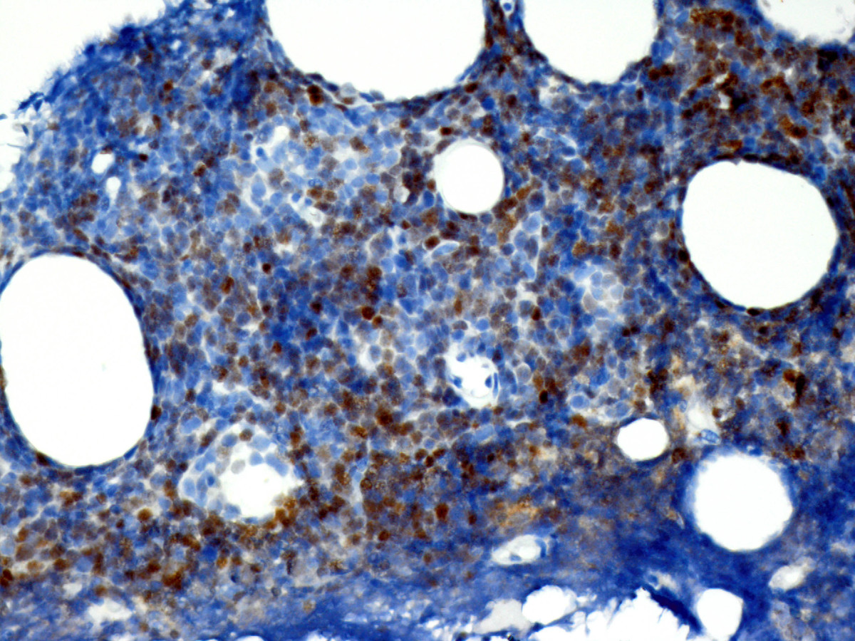 Mediastinal mass core biopsy (TdT)