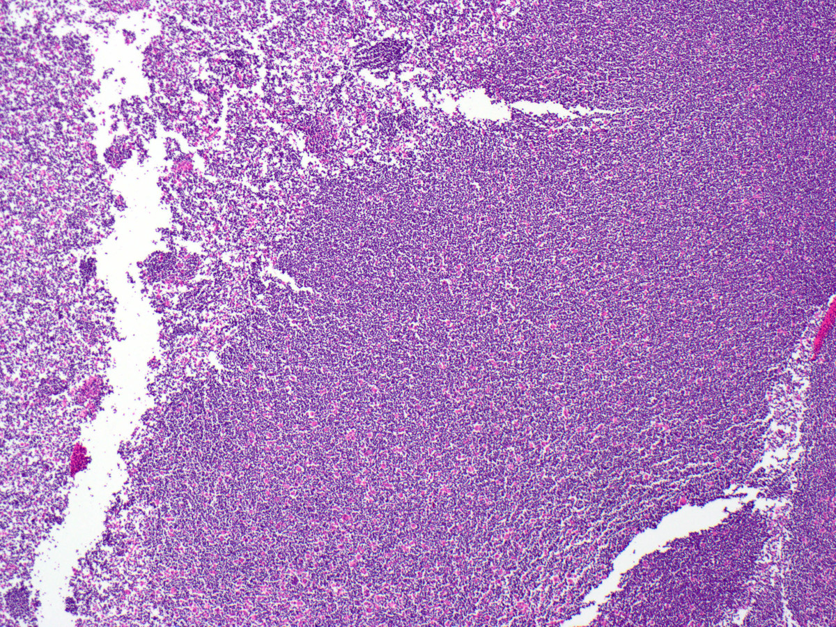 Mediastinal mass post-therapy biopsy, necrotic area
